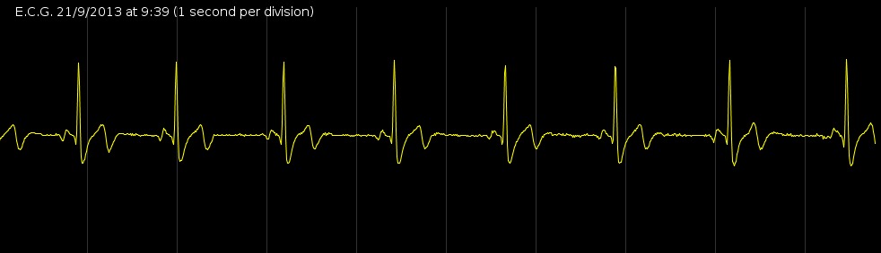 ecg trace